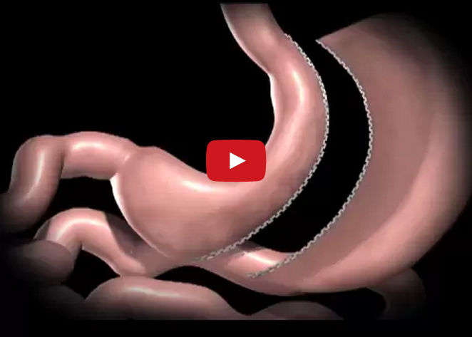 Laparoscopic sleeve gastrectomy
