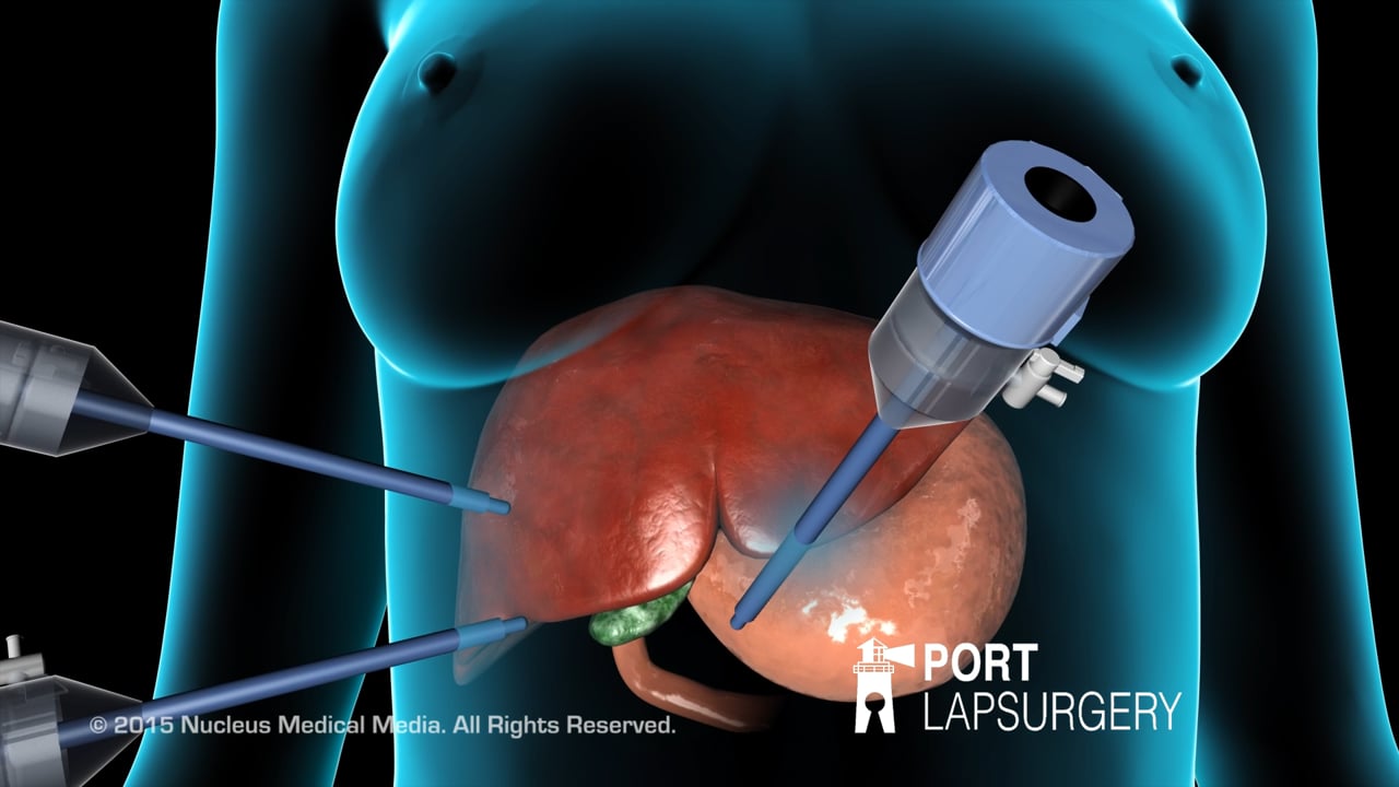Gall bladder surgery